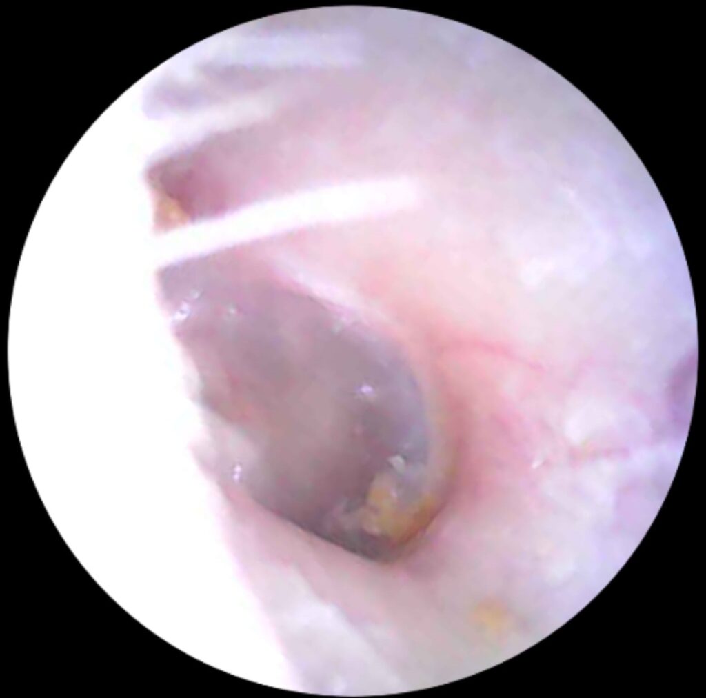 Blocked Ears? How to Spot the Signs and Safely Remove Earwax 3 image showing a clear ear after earwax removal appointment