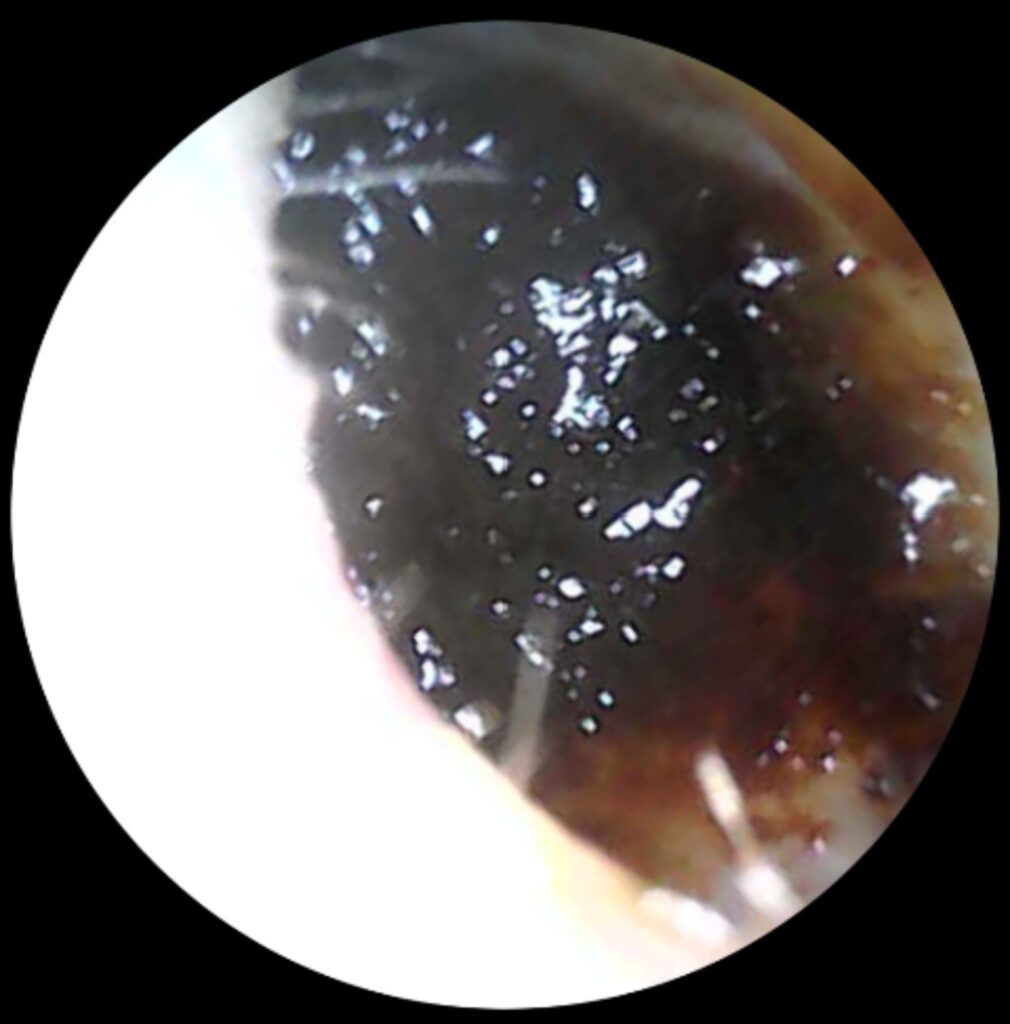 Blocked Ears? How to Spot the Signs and Safely Remove Earwax 1 image showing an ear blocked with earwax needing earwax removal